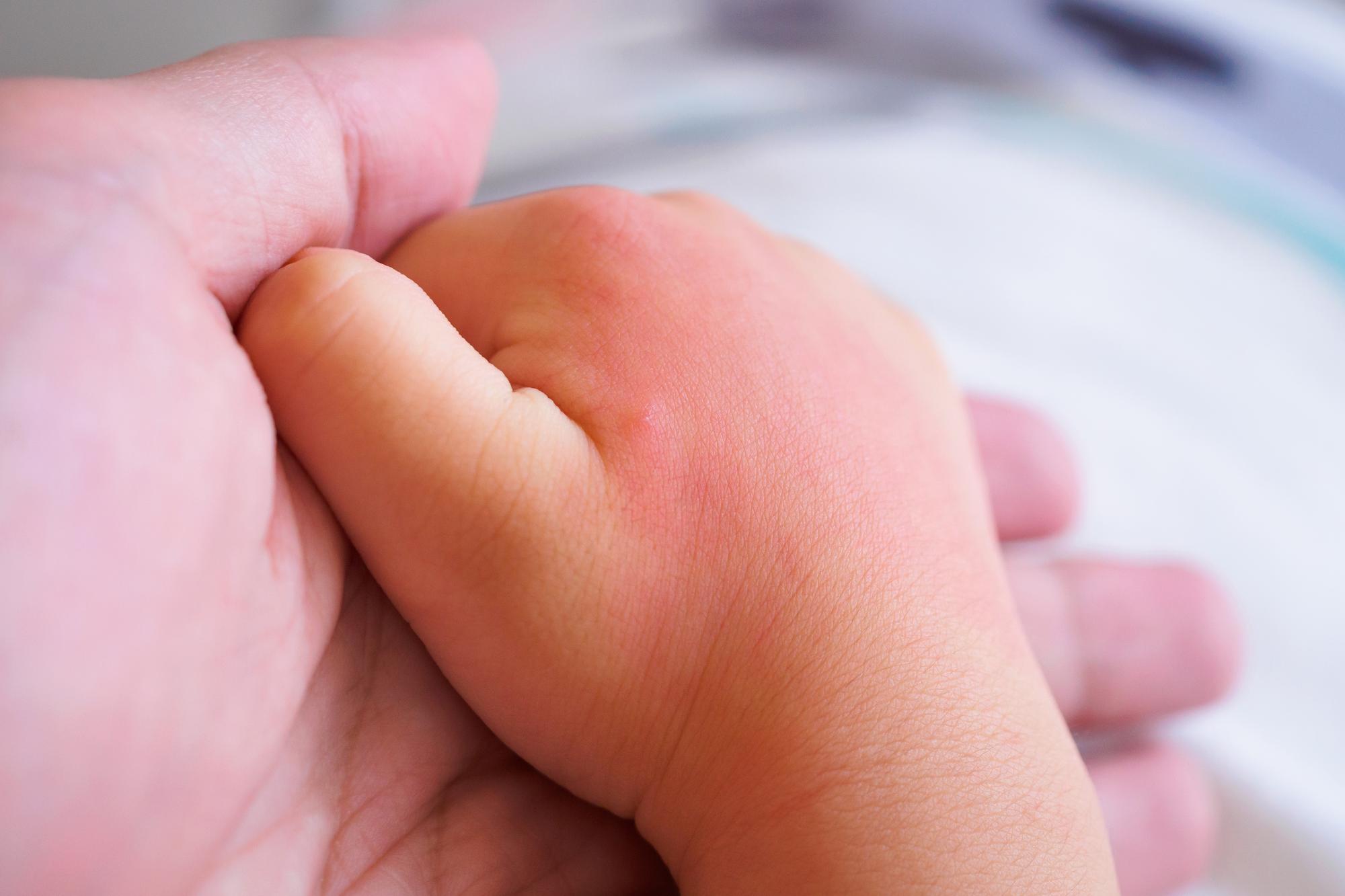 Comment savoir si c’est bien un ongle incarné chez bébé ?