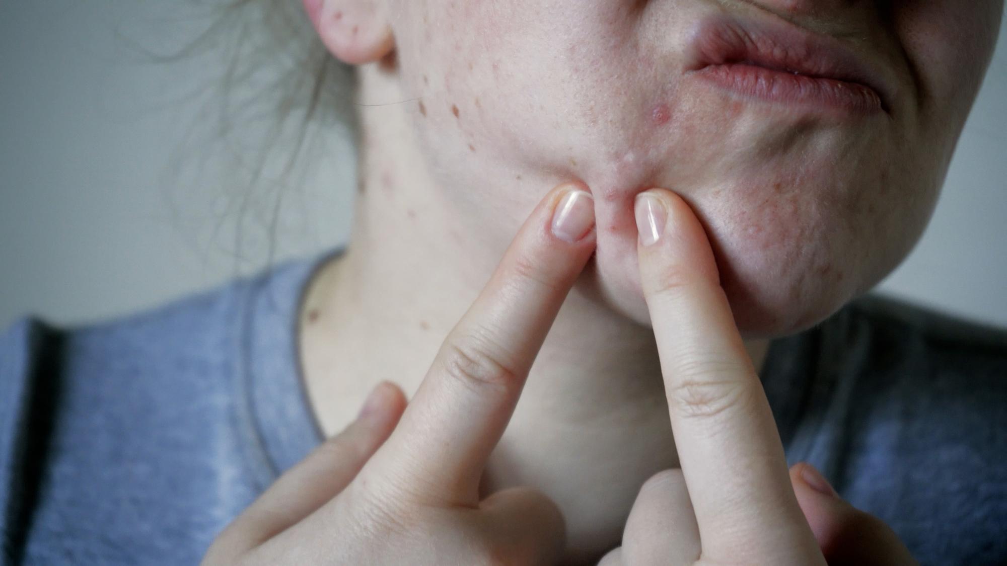 Comment un point noir peut-il s’infecter ?