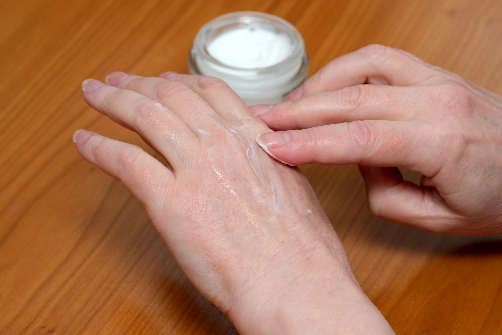 Quelle crème cicatrisante utiliser après la varicelle ?